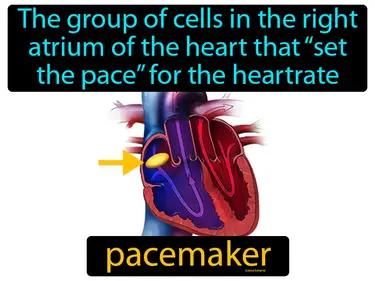 pacemaker Simple Definition