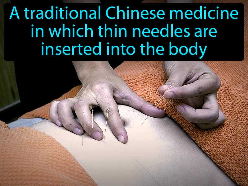 Acupuncture Definition Acupuncture Definition