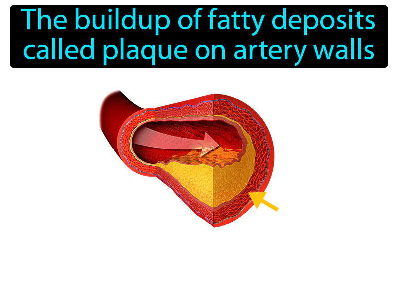 Atherosclerosis Definition Atherosclerosis Definition