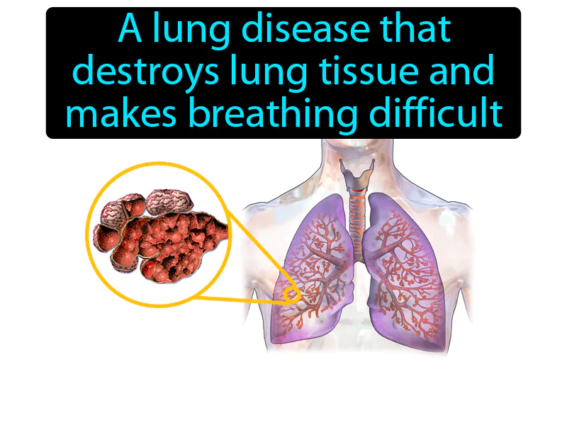 Emphysema Definition Emphysema Definition