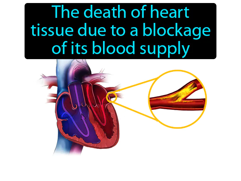 Heart Attack Definition