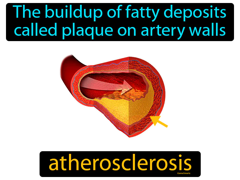 Atherosclerosis Definition Atherosclerosis Definition