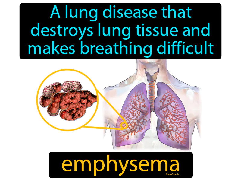 Emphysema Definition Emphysema Definition